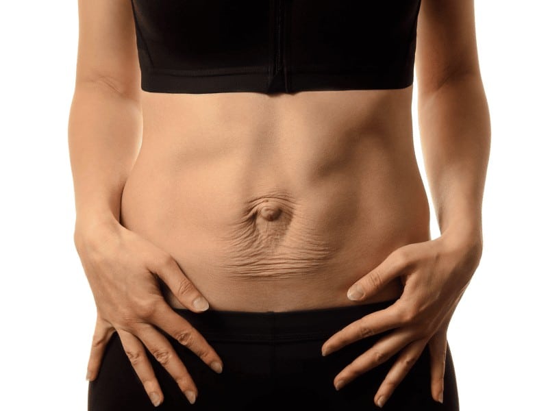 post partum woman with diastasis recti abdominis