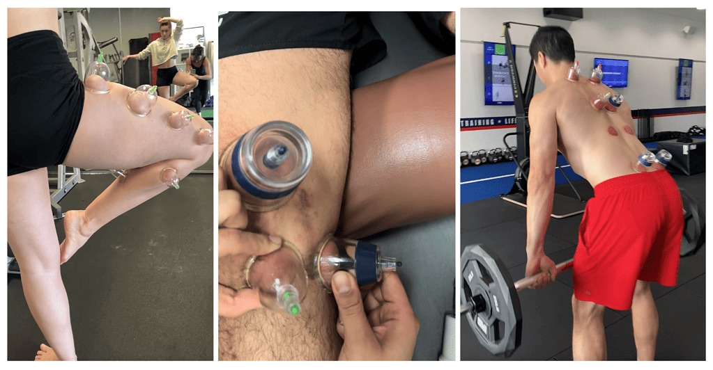 Three examples of cupping therapy being used on patients for physical therapy in orange county california