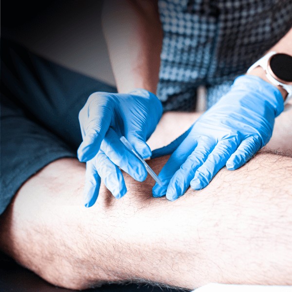 Close-up of dry needling therapy being applied to a patient's calf muscle to ease pain.