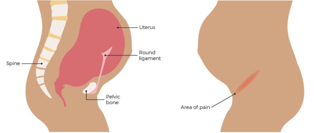 Diagram of where the round ligament sits relative to the spine and uterus.