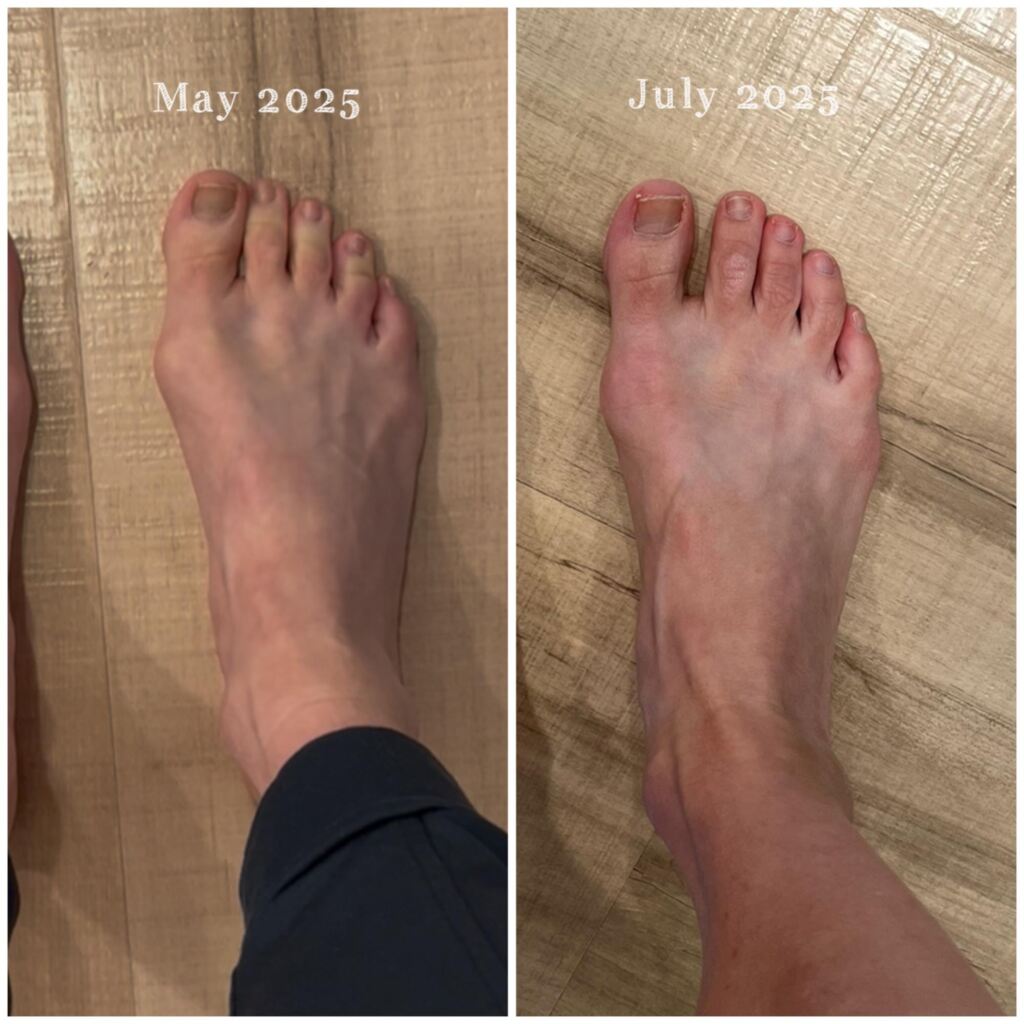 A side by side photo of two feet before and after bunion treatment.