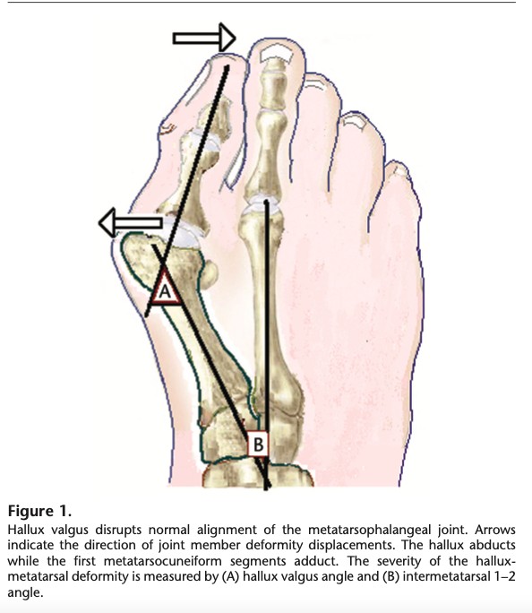 An anatomical diagram of the foot and how bunions are caused.
